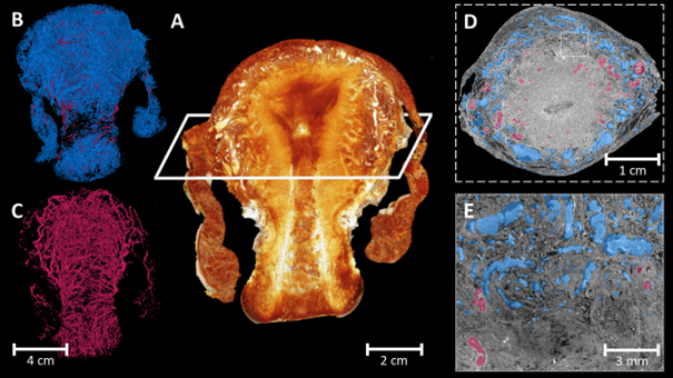 3D Synchrotron X-Ray Imaging of Uterine Vasculature in Adenomyosis